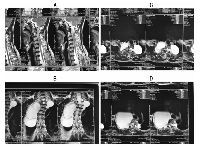 多发巨大神经根鞘囊肿1例并文献分析