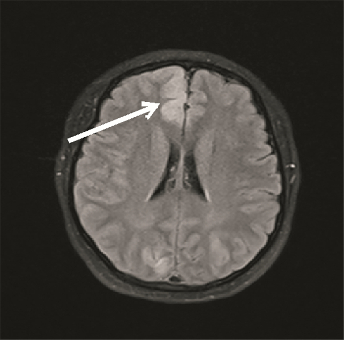 2017年7月9日mri示双侧额顶叶中线旁脑实质肿胀(箭头所示 图