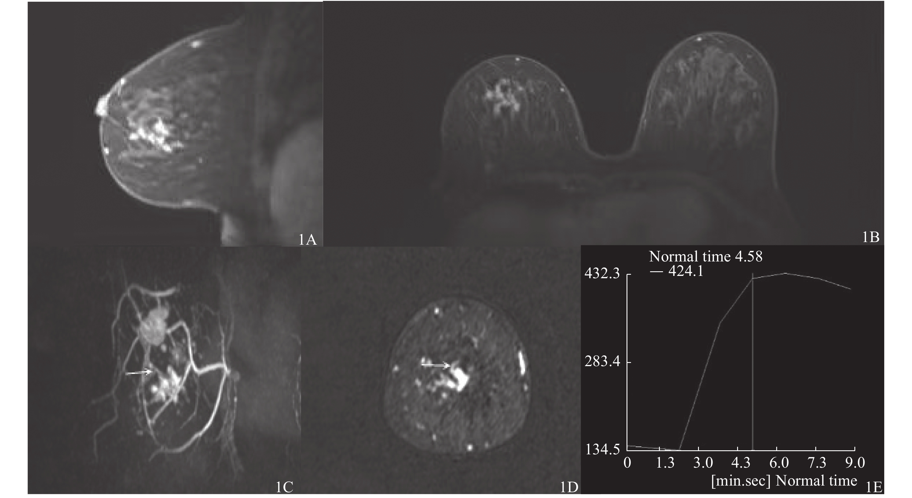 乳腺导管内原位癌的MRI特征与HER-2表达的相关性分析