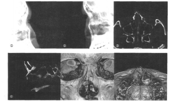 鼻骨双侧位摄影与螺旋ct检查在鼻骨骨折中的应用分析