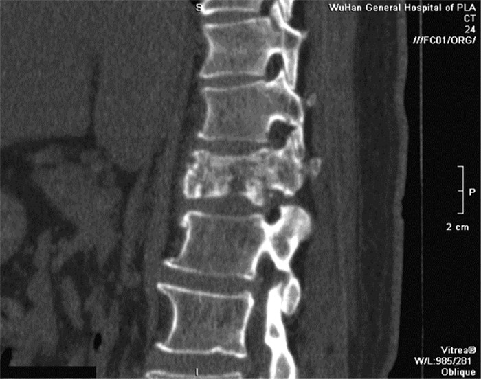 以胸椎转移为首发症状的甲状腺透明细胞癌1例报道