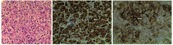 17a-羟化酶/17, 20-碳裂解酶部分缺陷合并肾上腺腺瘤1例报道