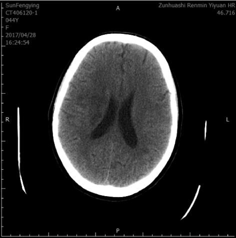 2017-4-28复查头ct,示右侧基底节区,右侧额颞叶低密度影 图选项