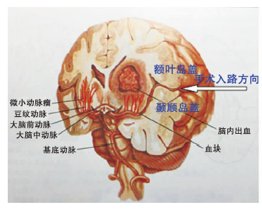 經外側裂-島葉路徑顯微手術治療基底節區腦出血