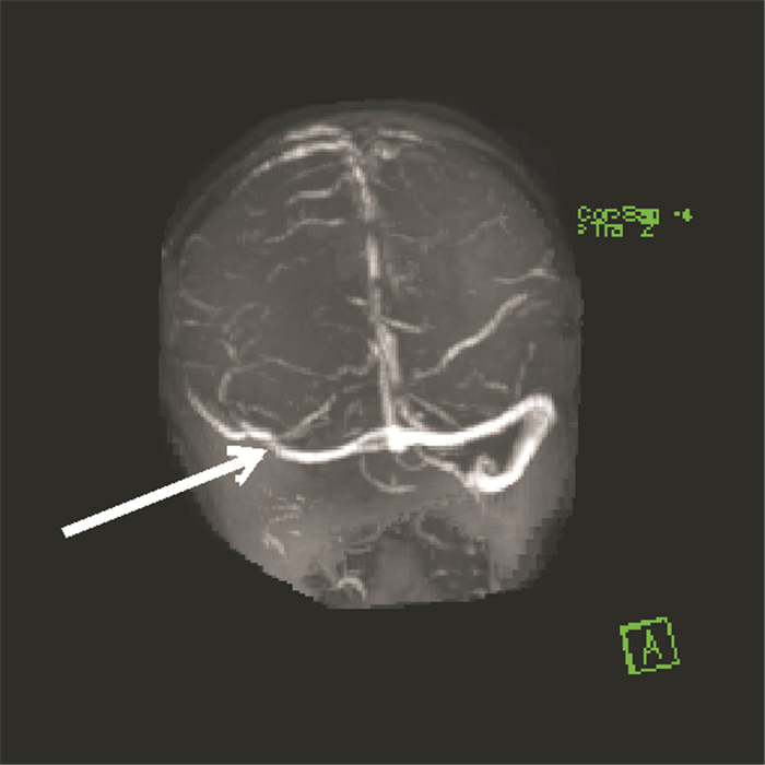 疑似為急性腦梗死的顱內靜脈竇血栓形成1例報道