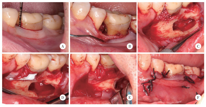 下颌磨牙根尖脓肿经邻牙根分叉引流致邻牙牙周脓肿1例报道