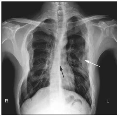 Post-traumatic cerebrospinal fluid rhinorrhea associated with ...