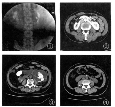 先天性马蹄肾影像诊断