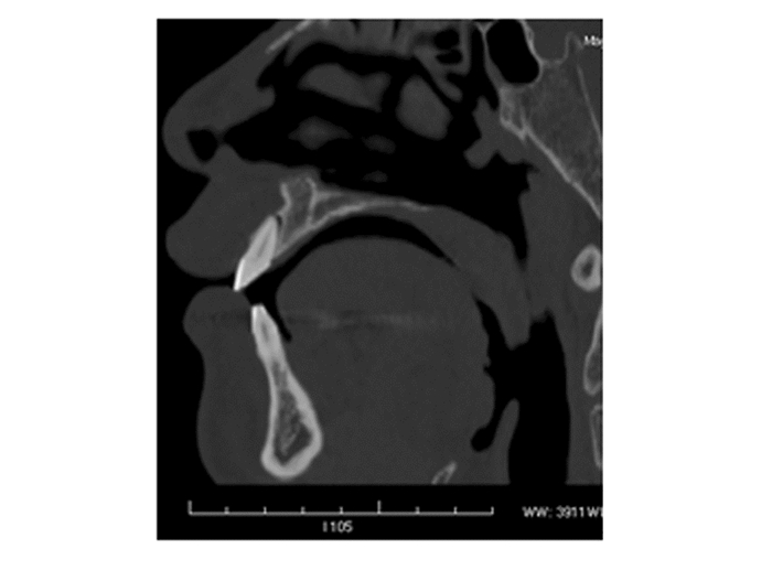 创伤性恒切牙不全脱位口腔全景和ct表现对比分析
