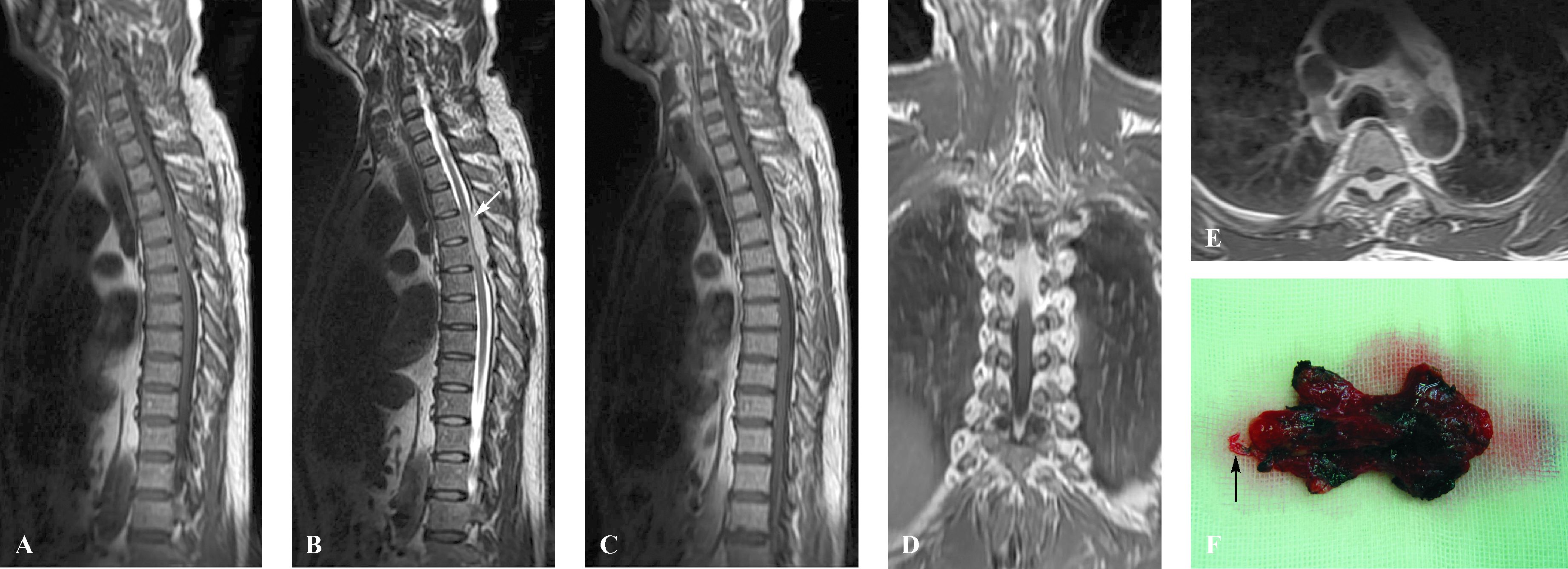 单纯椎管内硬脊膜外海绵状血管瘤一例