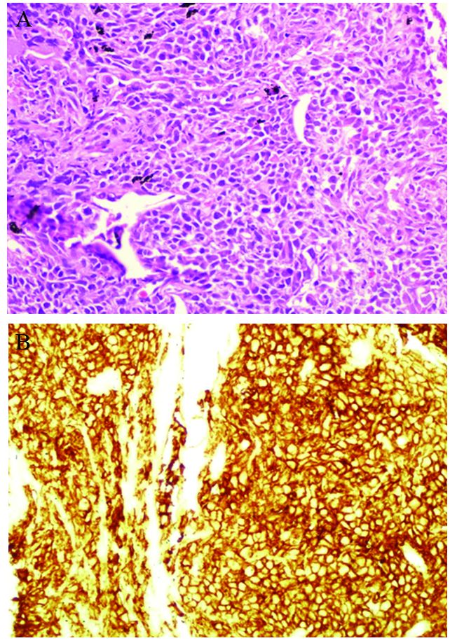 normal alveolar structure was effaced by a diffuse lymphomatous