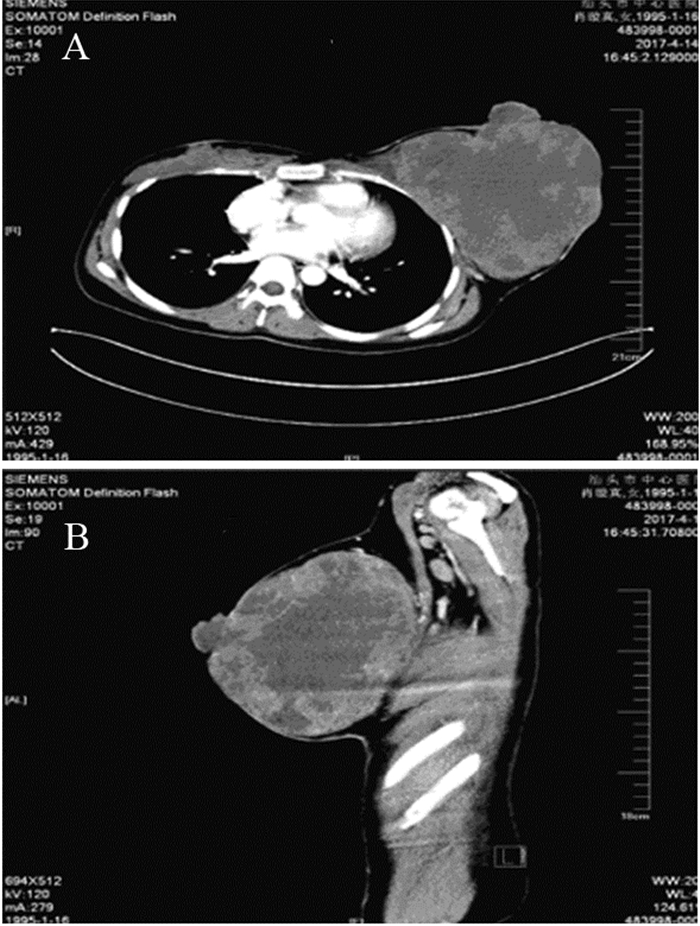 生长迅速的年轻女性乳腺恶性叶状肿瘤1例报道